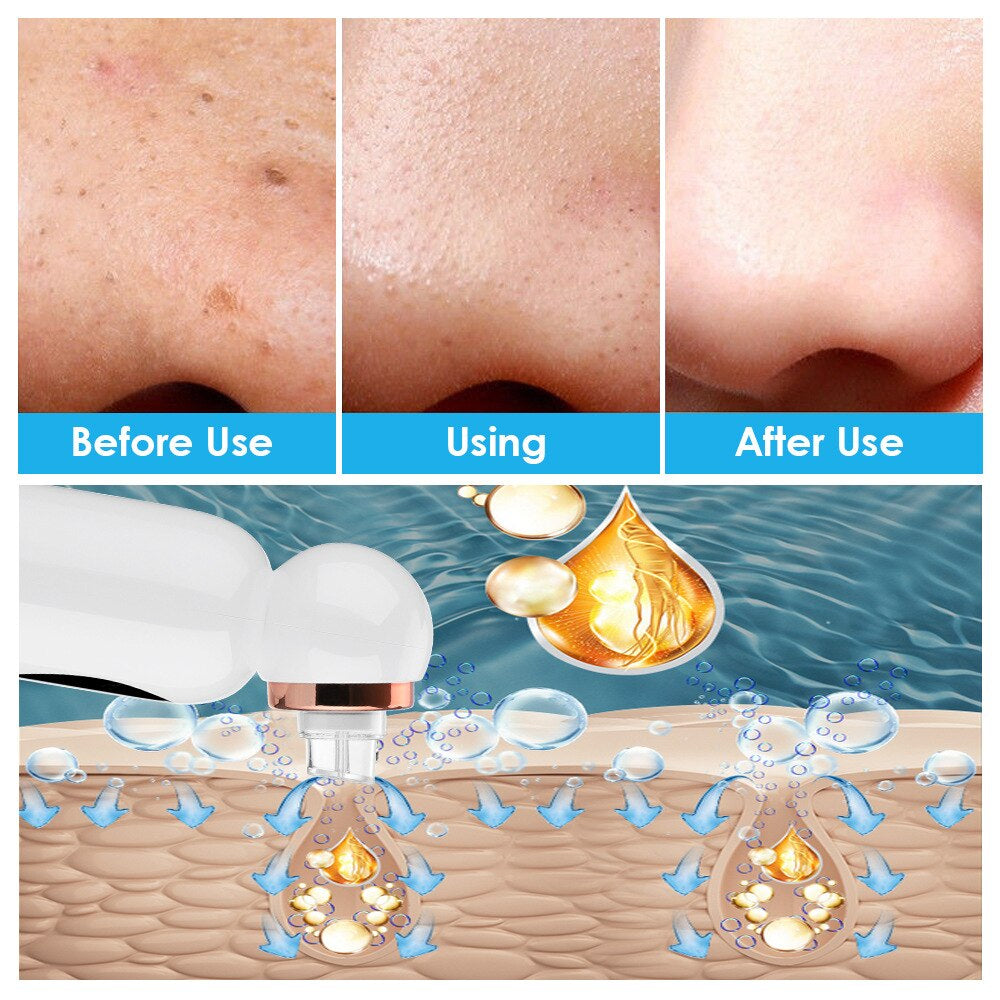 Hydrodermabrasion Mitesserentferner